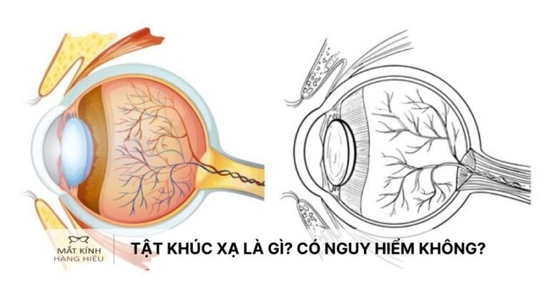 Tat-khuc-xa-la-gi-Tat-khuc-xa-co-nguy-hiem-khong