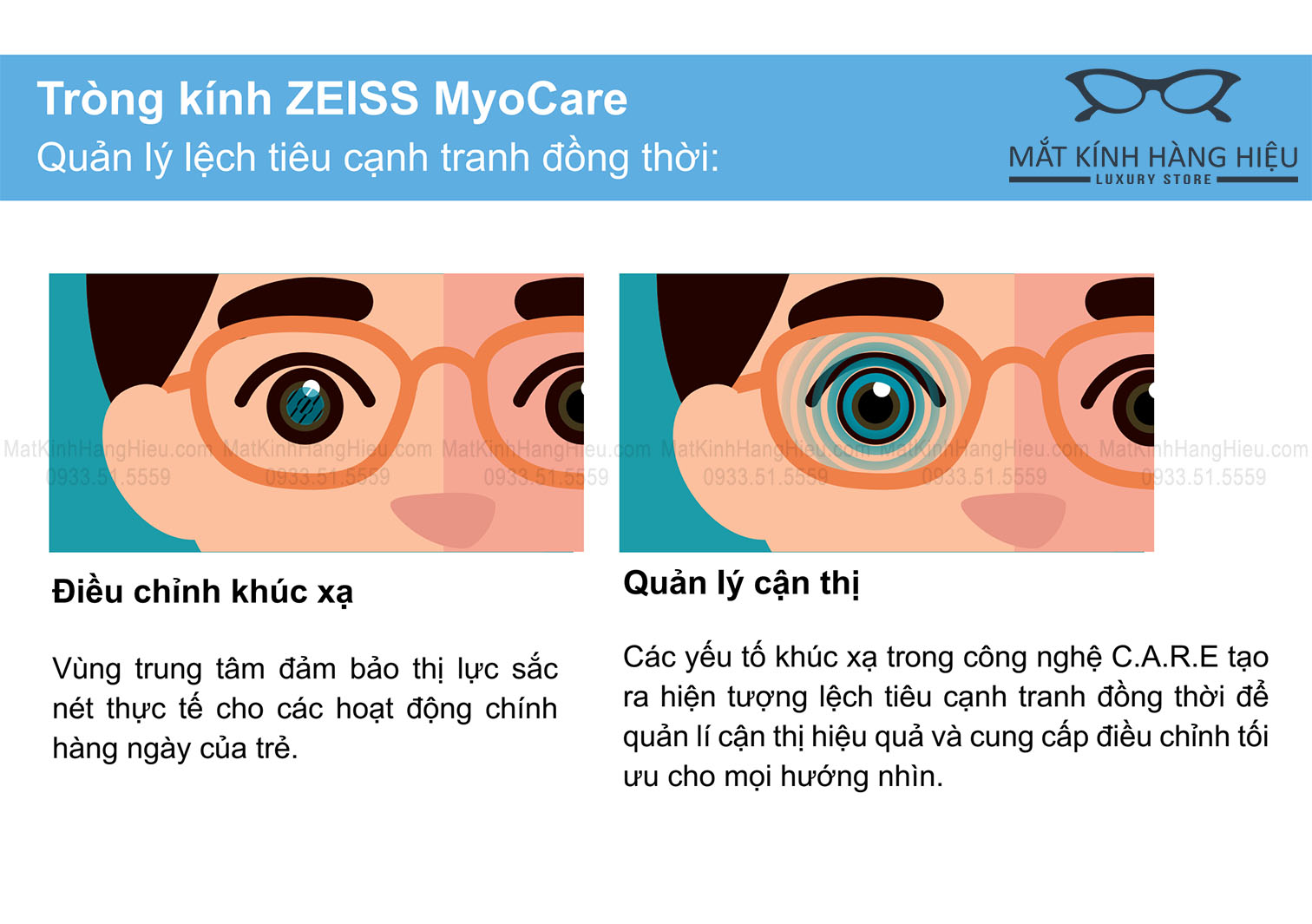 Tròng kính Zeiss MyoCare kiểm soát cận thị - vùng điều trị